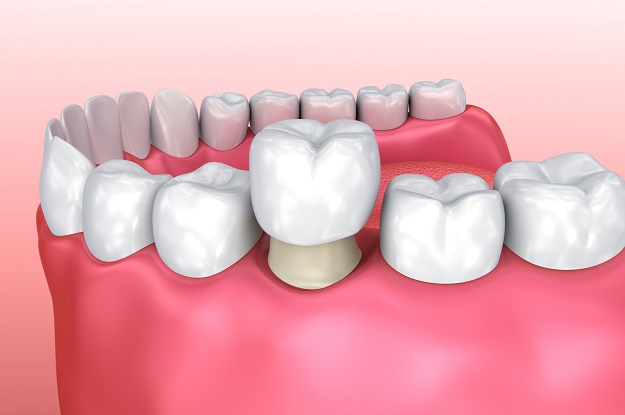 dental crowns houston tx