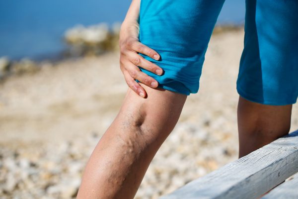 What Kind of Doctor Treats Varicose Veins