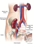 Kidney Transplant in Pune | Kidney Specialist in Pune – Dr. Ninad Deshmukh