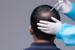 Best Hair Loss Treatment in Bangalore| Trichologist – Dr. Health Clinic
