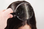 Best Dandruff Treatment at Bangalore | Dr. Health Hair Clinic