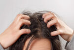 Best Scalp Infections Treatment in Bangalore – Dr. Health Hair Clinic