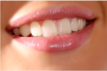 Smile Designing in gk1-orion Dental clinic