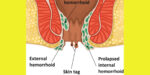 The Difference Between a Haemorrhoid and Skin Tag