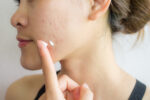 Need Prescription Acne Relief? Buy Differin Cream for Acne Treatment.