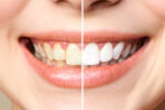 Best Cosmetic Dentist in Delhi