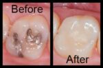 Replacing silver amalgam fillings in the mouth by “SMART” protocol
