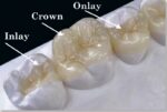 Dental Inlay/Onlay-The forgotten restorations
