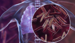 How To Prevent Tuberculosis: Symptoms, Treatment & Vaccination