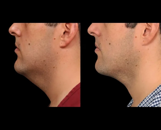 Double chin removal