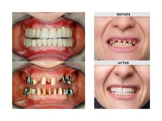 Dental Implants Houston