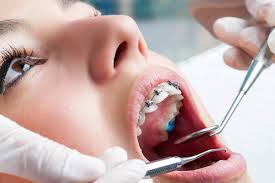dental veneers near me
