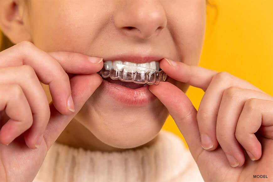 The Connection Between Invisalign and Improved Oral Health