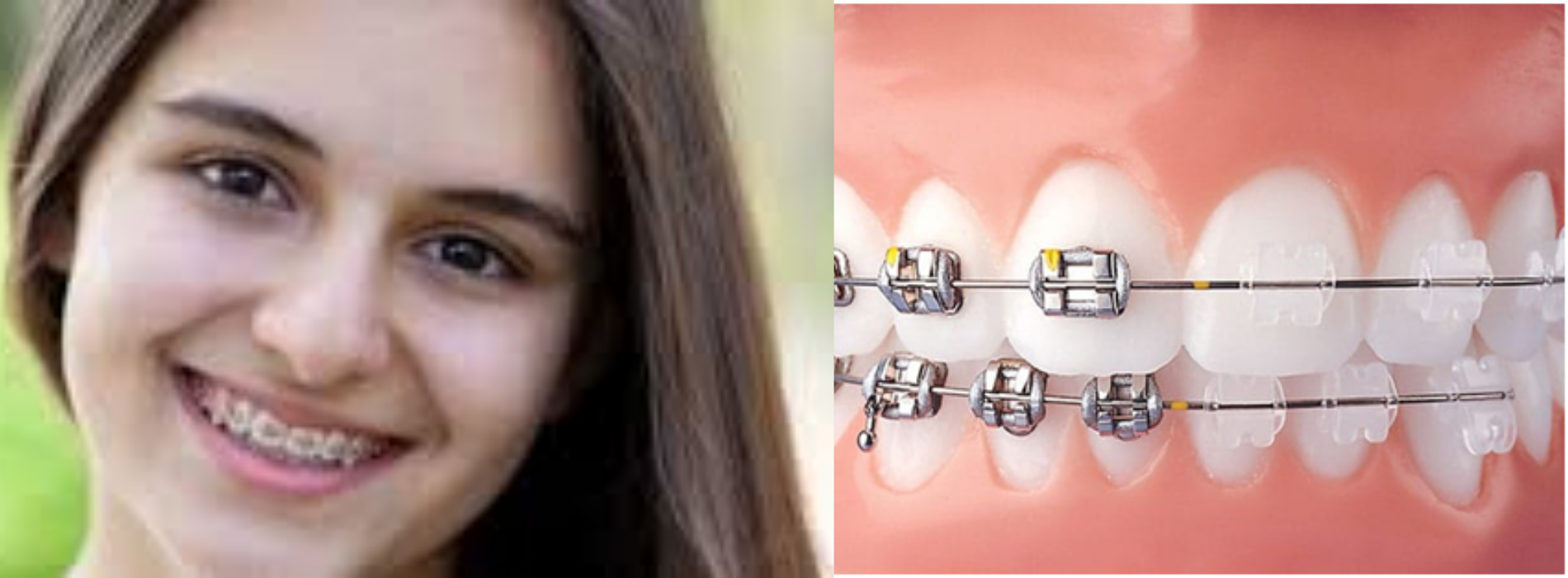 invisalign braces