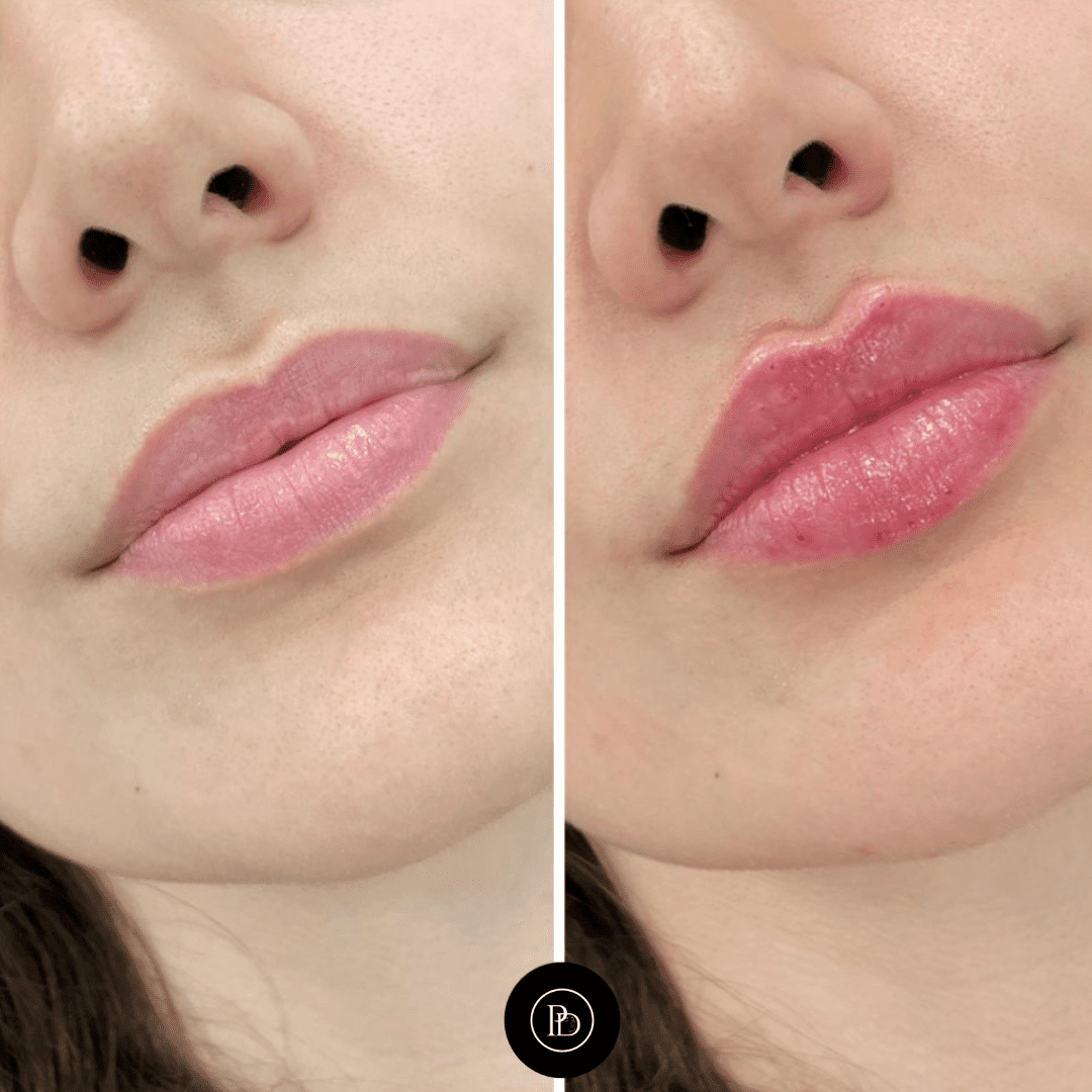 Juvederm fillers