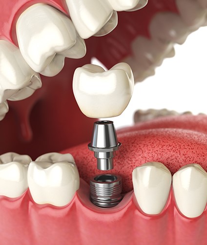 professional teeth whitening