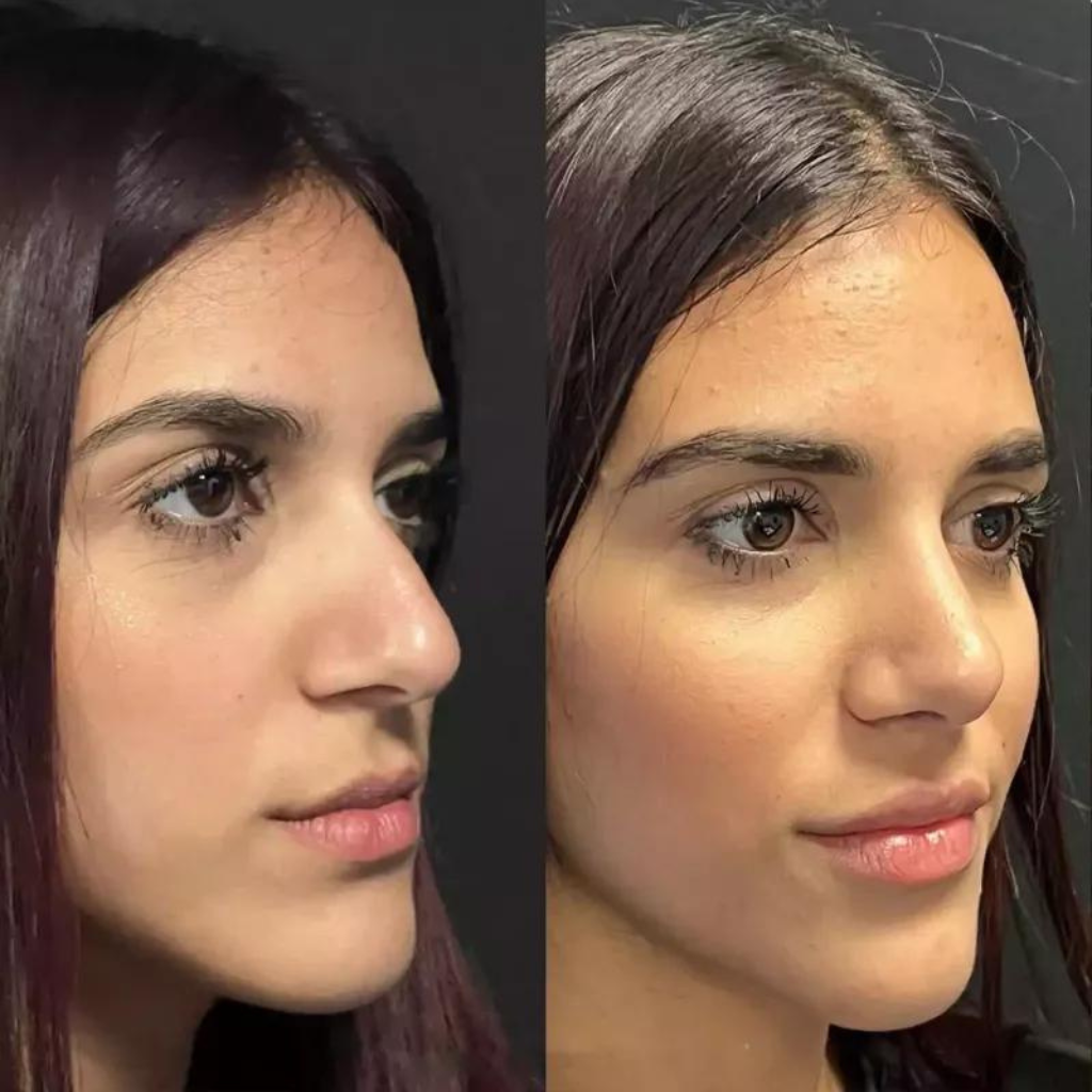 Discover the Best Rhinoplasty Surgeons in Dubai for a Perfect Nose Job