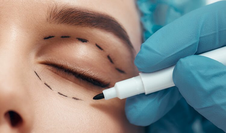 What should I expect during an eyelid surgery consultation in Dubai