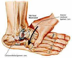 anterior talofibular ligament tear recovery time