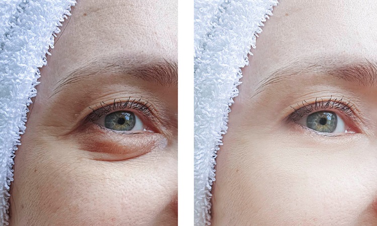 eye lift cost