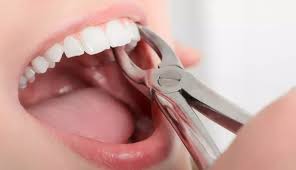 Tooth Extraction in Canberra