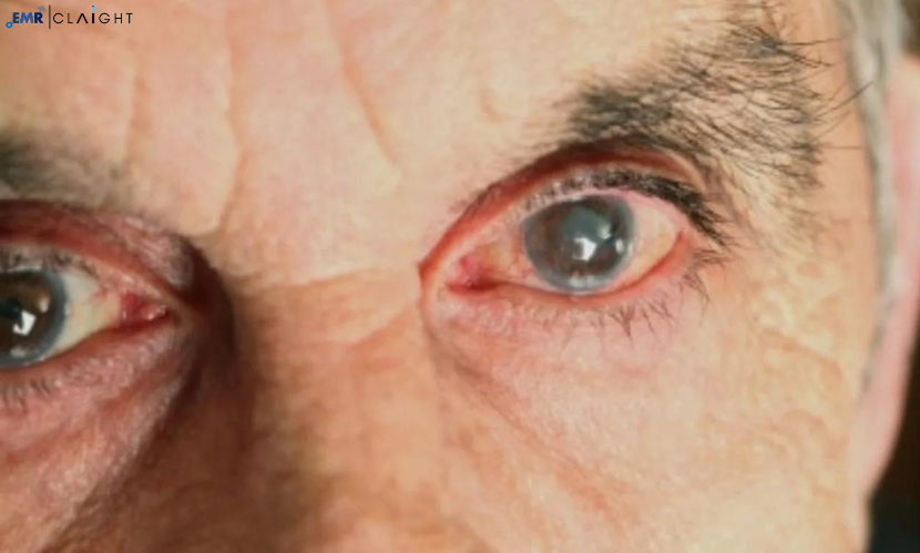 Macular Degeneration Drug Pipeline Analysis