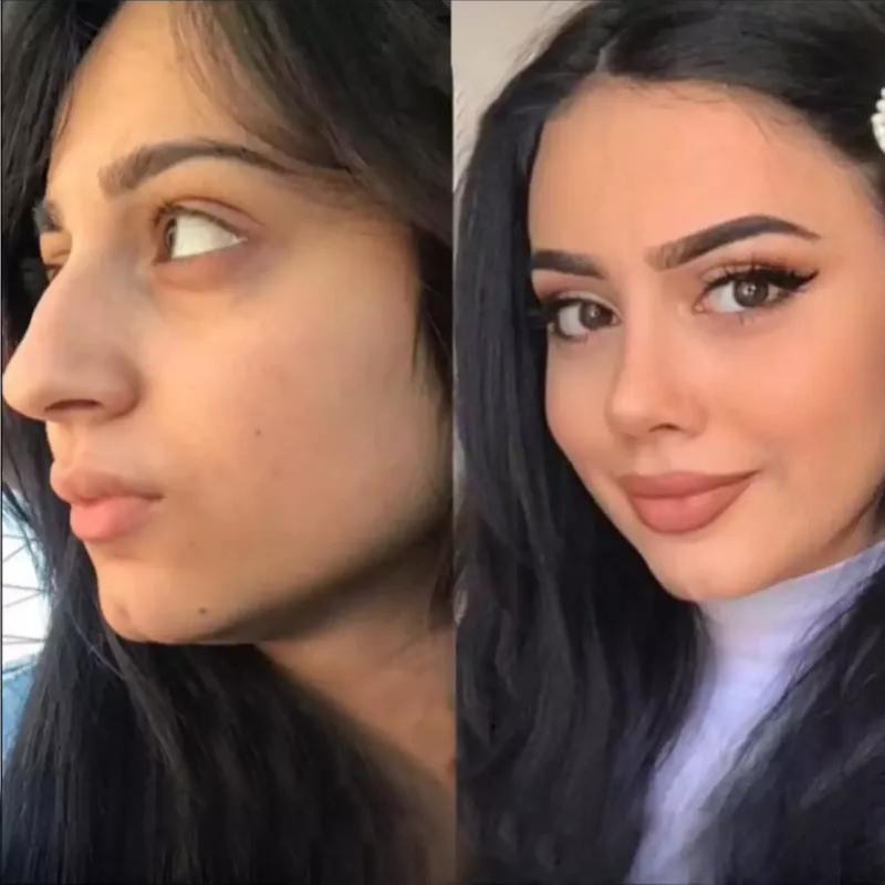 Rhinoplasty in Dubai: Post-Surgery Skincare